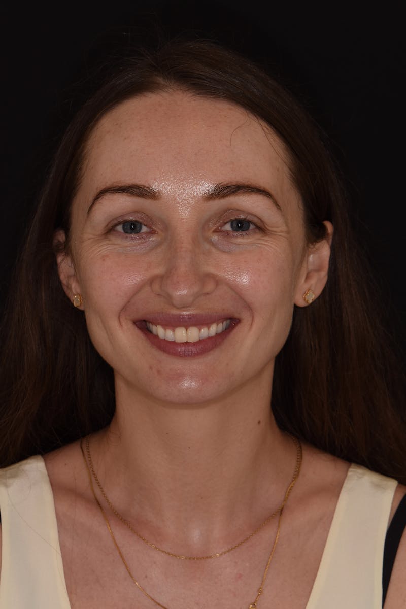 Patient Smile Before & After Gallery - Patient 345313 - Image 1