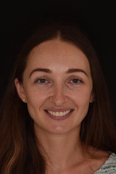 Patient Smile Before & After Gallery - Patient 345313 - Image 2