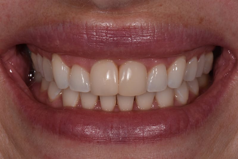 Patient Smile Before & After Gallery - Patient 345313 - Image 3