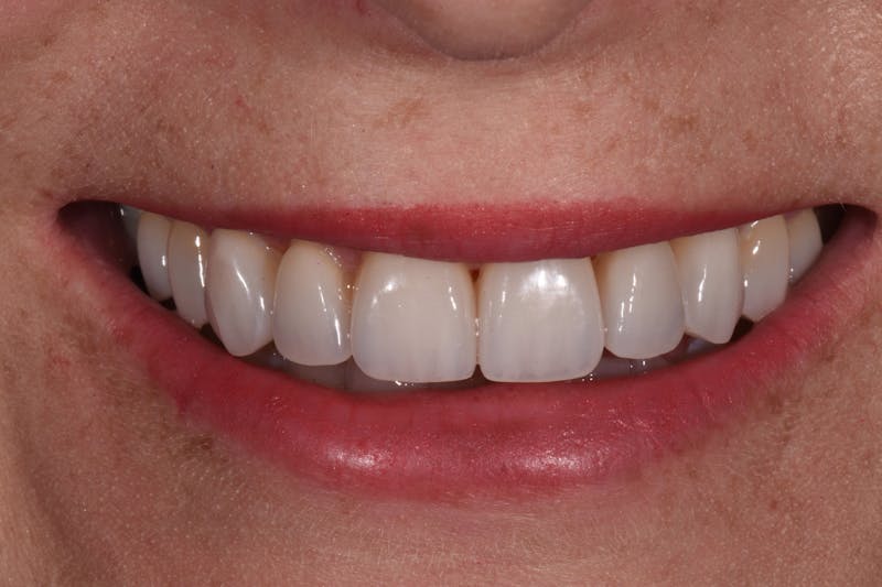 Patient Smile Before & After Gallery - Patient 345313 - Image 4