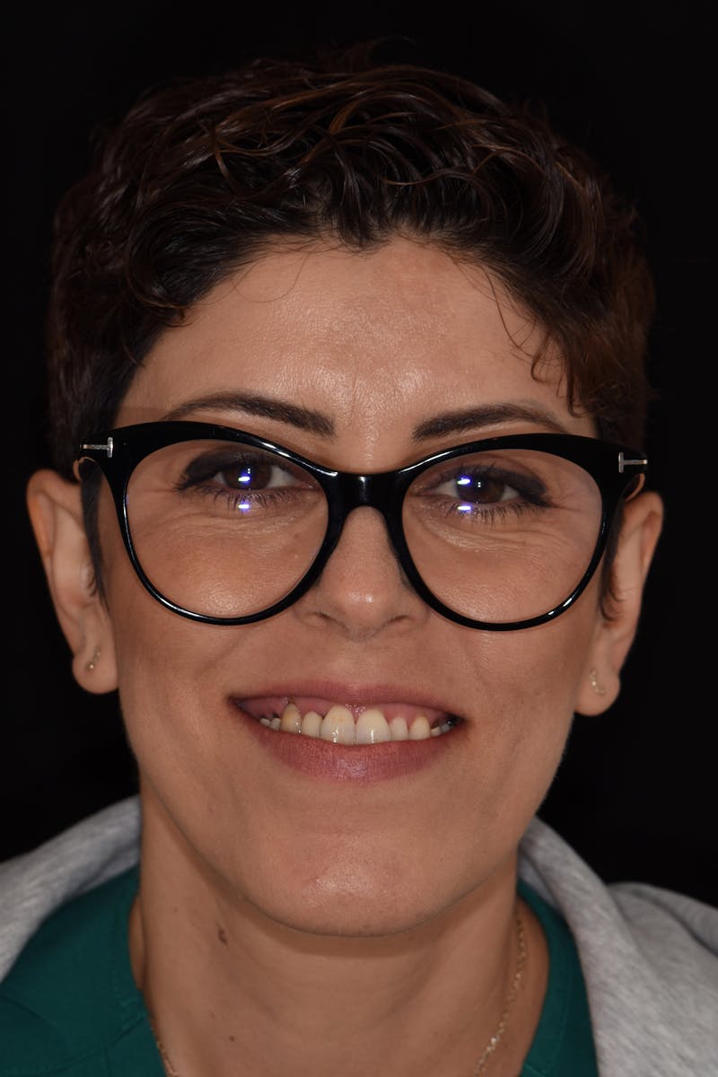 Patient Smile Before & After Gallery - Patient 316013 - Image 1