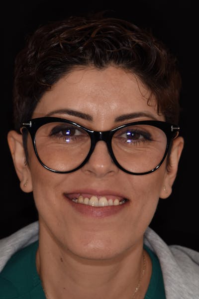 Patient Smile Before & After Gallery - Patient 316013 - Image 1