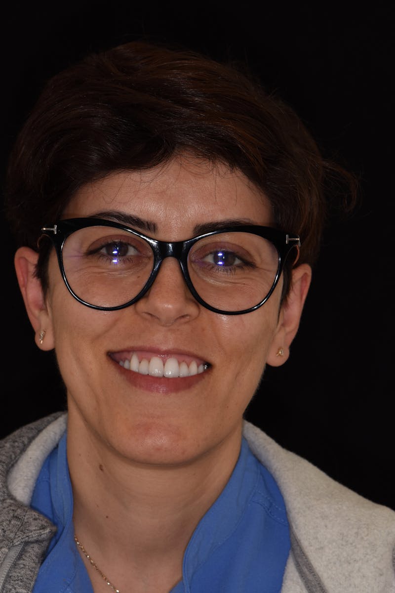 Patient Smile Before & After Gallery - Patient 316013 - Image 2