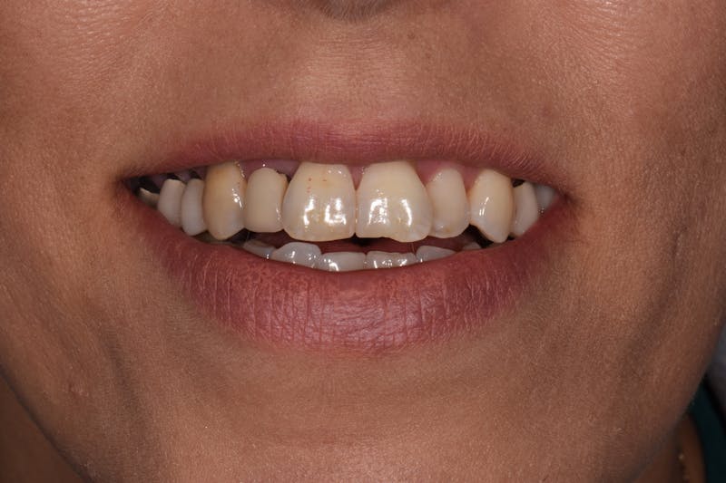 Patient Smile Before & After Gallery - Patient 316013 - Image 3