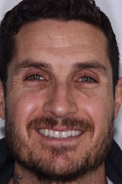 Patient Smile Before & After Gallery - Patient 789560 - Image 1