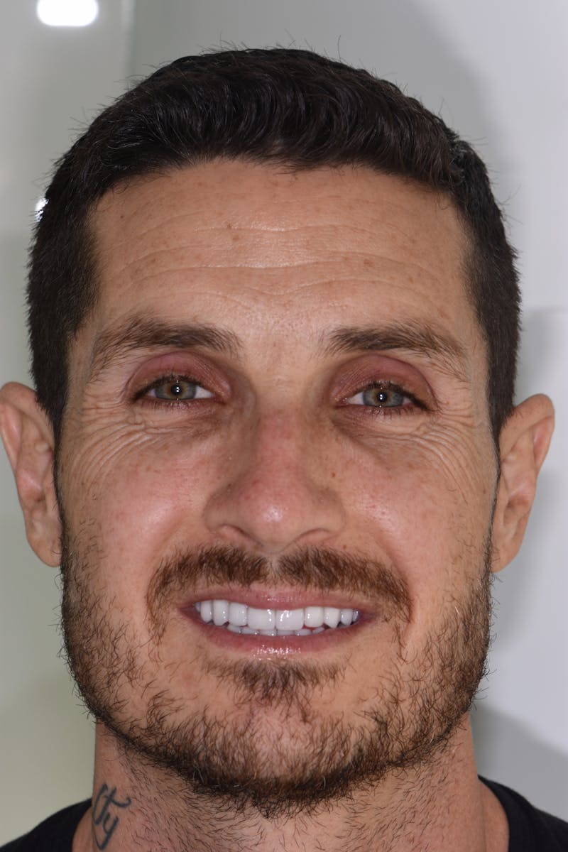 Patient Smile Before & After Gallery - Patient 789560 - Image 2