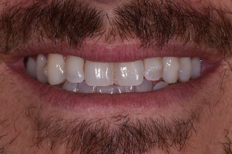 Patient Smile Before & After Gallery - Patient 789560 - Image 3