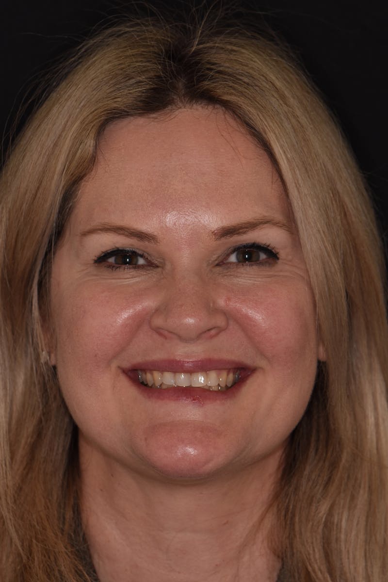 Patient Smile Before & After Gallery - Patient 182099 - Image 1