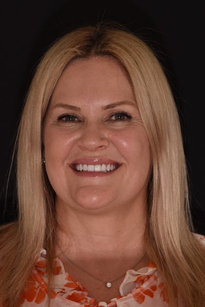 Patient Smile Before & After Gallery - Patient 182099 - Image 2