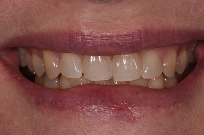 Patient Smile Before & After Gallery - Patient 182099 - Image 3