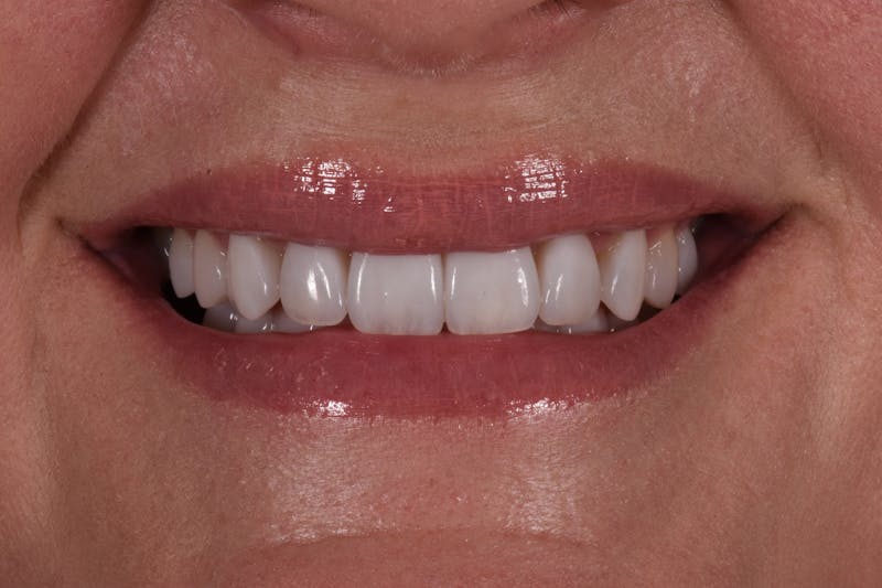 Patient Smile Before & After Gallery - Patient 182099 - Image 4