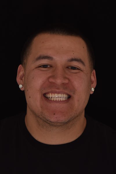 Patient Smile Before & After Gallery - Patient 418843 - Image 1