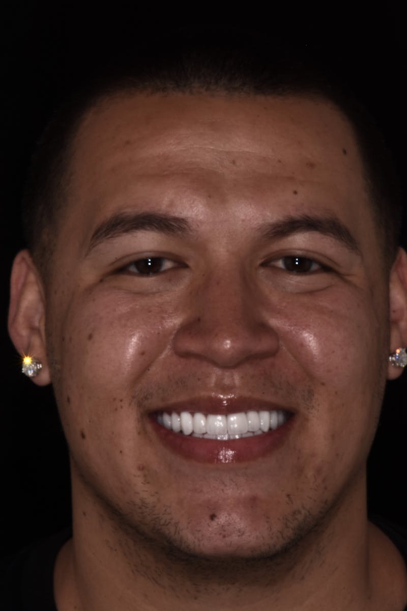 Patient Smile Before & After Gallery - Patient 418843 - Image 2