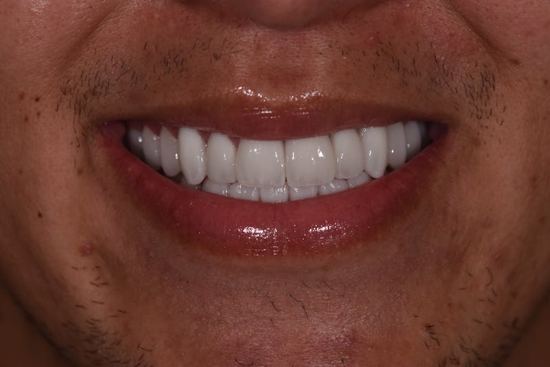 Patient Smile Before & After Gallery - Patient 418843 - Image 4