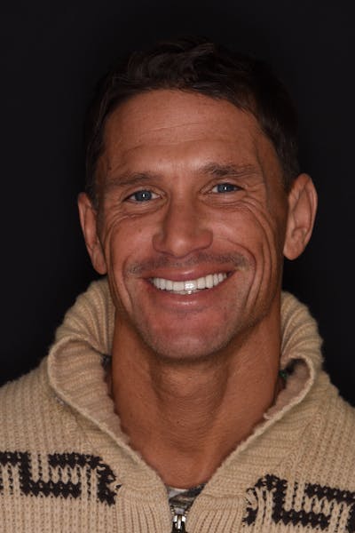 Patient Smile Before & After Gallery - Patient 232660 - Image 2