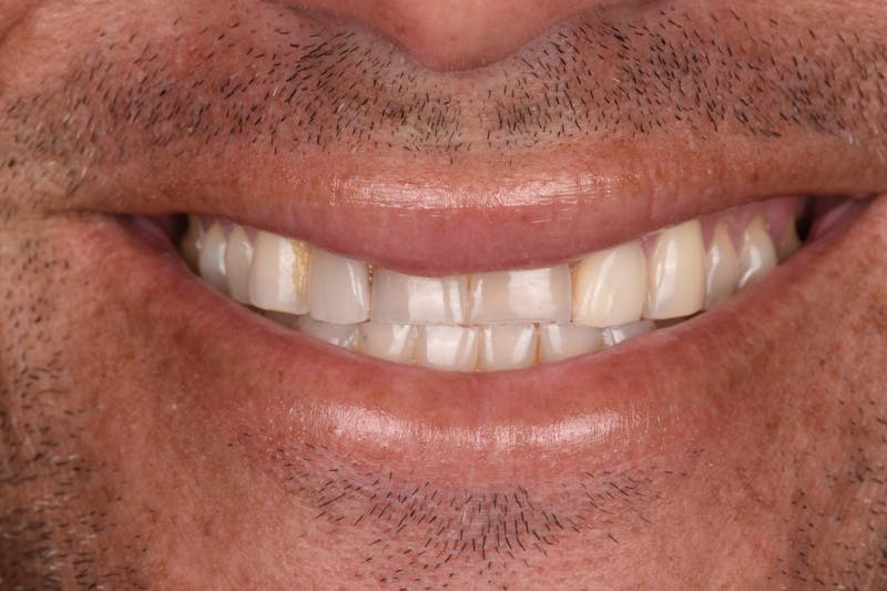 Patient Smile Before & After Gallery - Patient 232660 - Image 3
