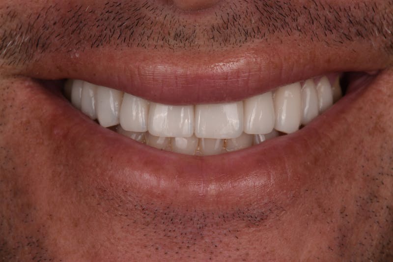 Patient Smile Before & After Gallery - Patient 232660 - Image 4