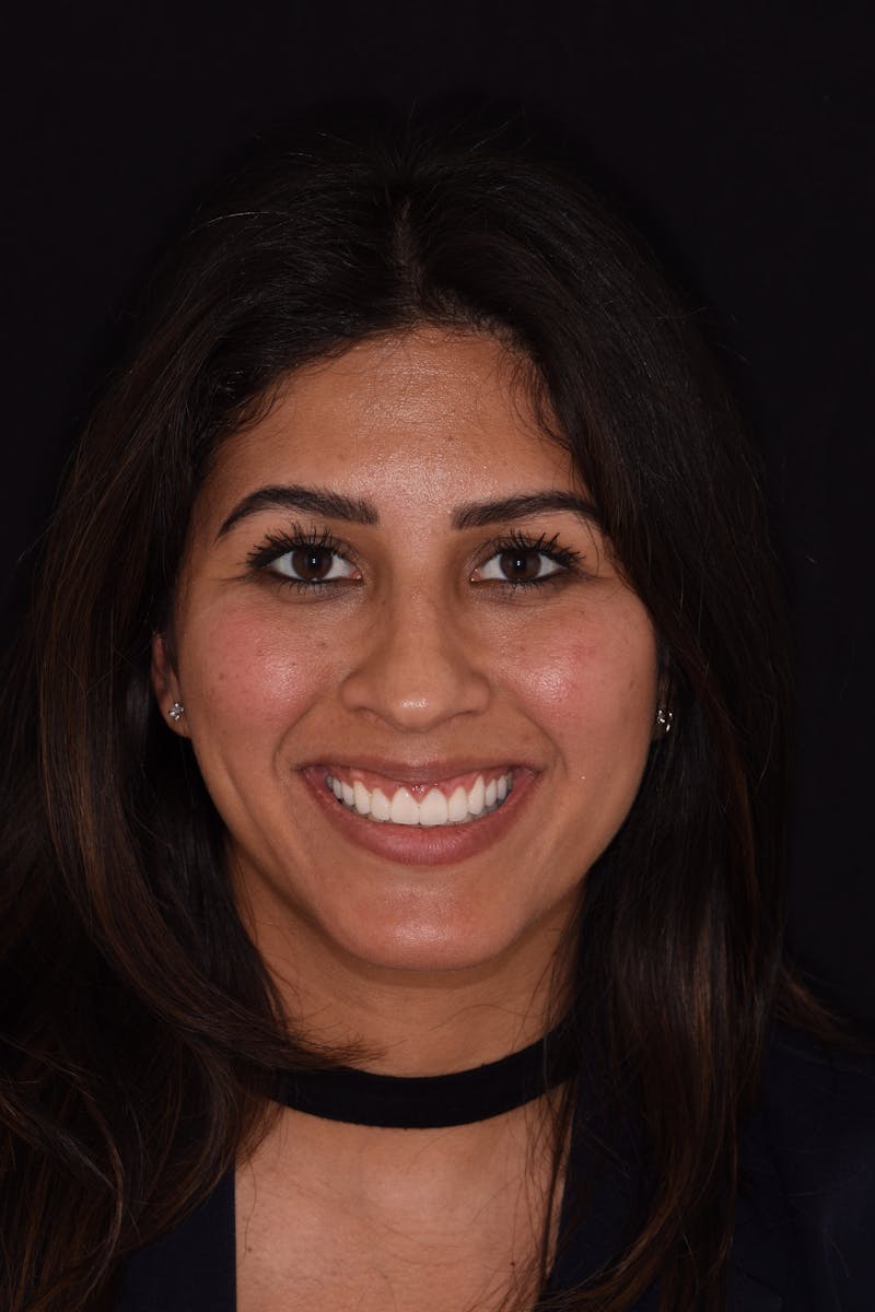 Patient Smile Before & After Gallery - Patient 286126 - Image 2