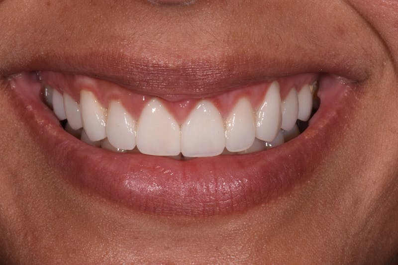 Patient Smile Before & After Gallery - Patient 286126 - Image 4