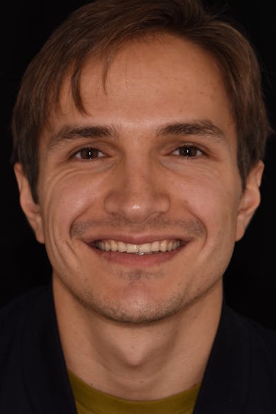 Patient Smile Before & After Gallery - Patient 363879 - Image 1