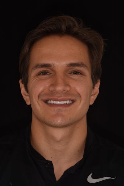 Patient Smile Before & After Gallery - Patient 363879 - Image 2