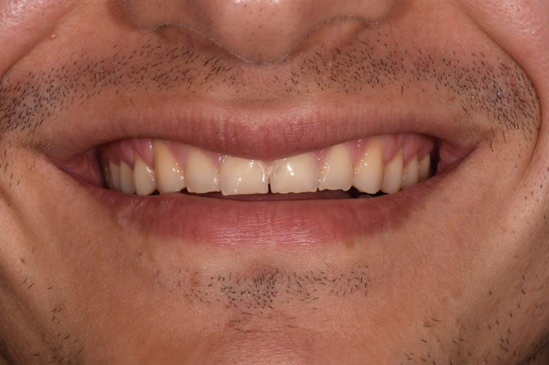 Patient Smile Before & After Gallery - Patient 363879 - Image 3