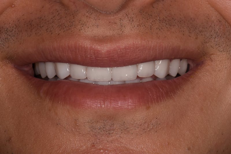 Patient Smile Before & After Gallery - Patient 363879 - Image 4