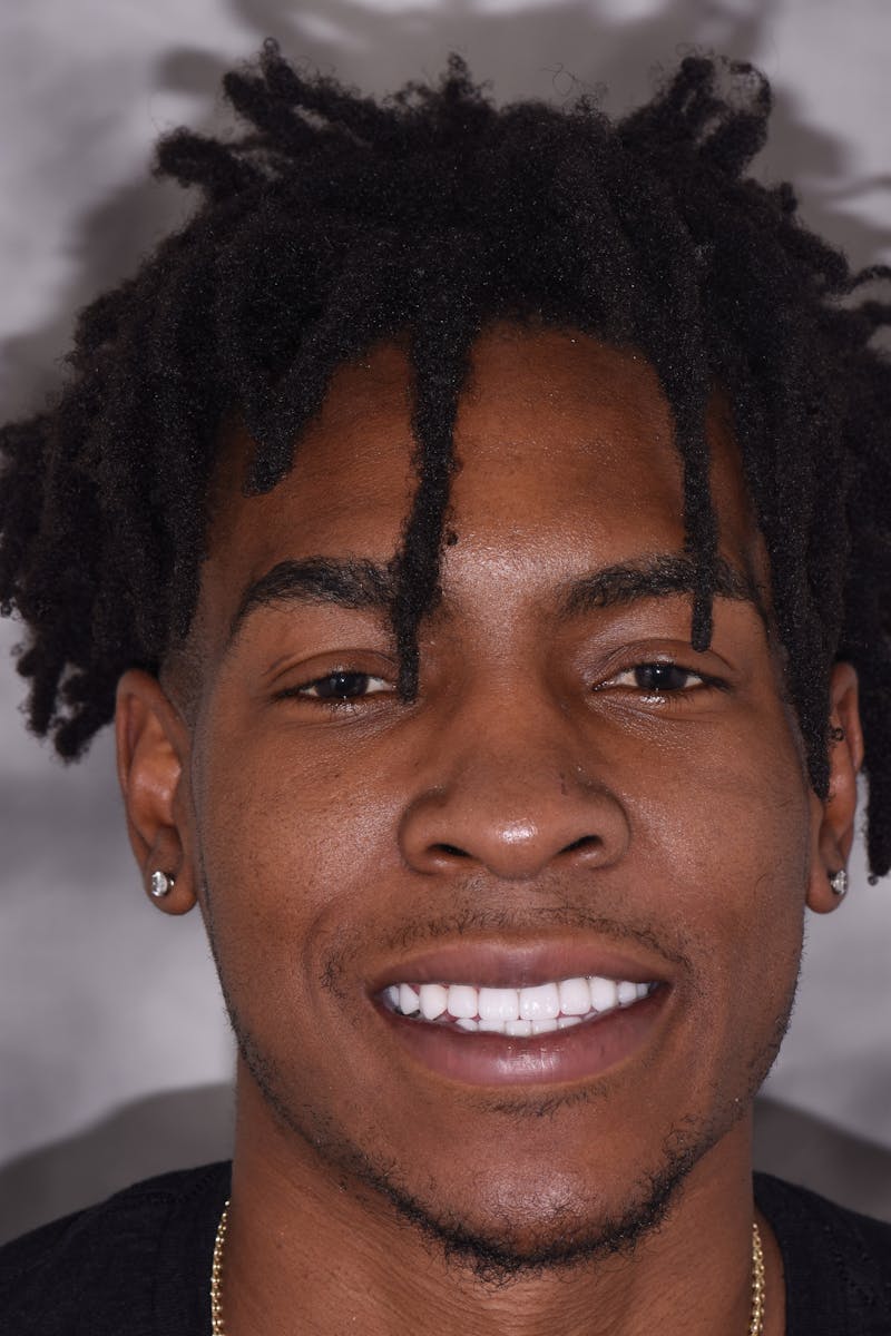 Patient Smile Before & After Gallery - Patient 231837 - Image 2