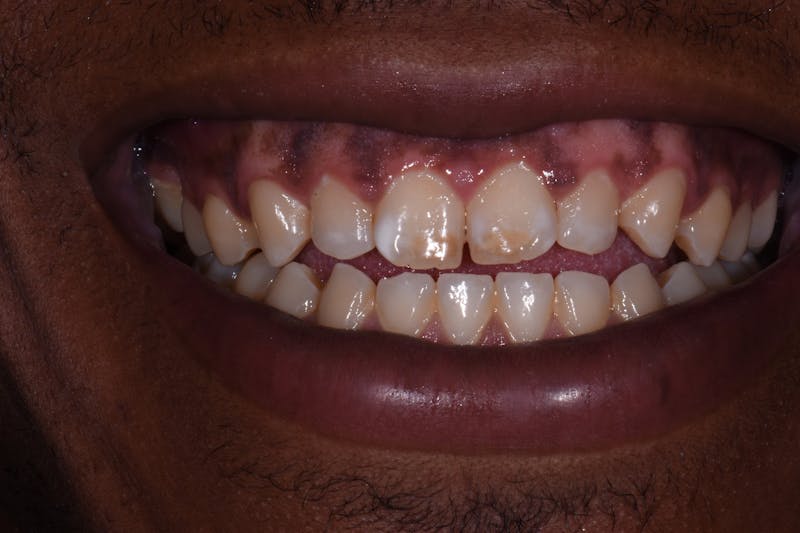 Patient Smile Before & After Gallery - Patient 231837 - Image 3