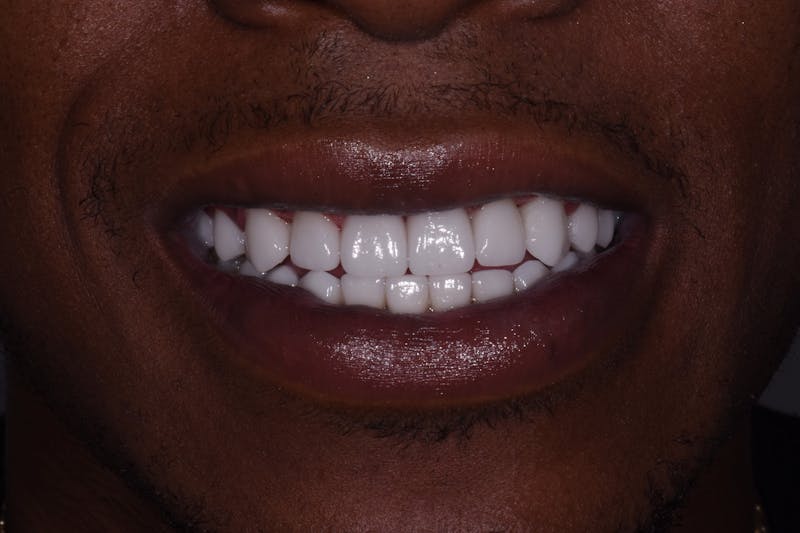 Patient Smile Before & After Gallery - Patient 231837 - Image 4