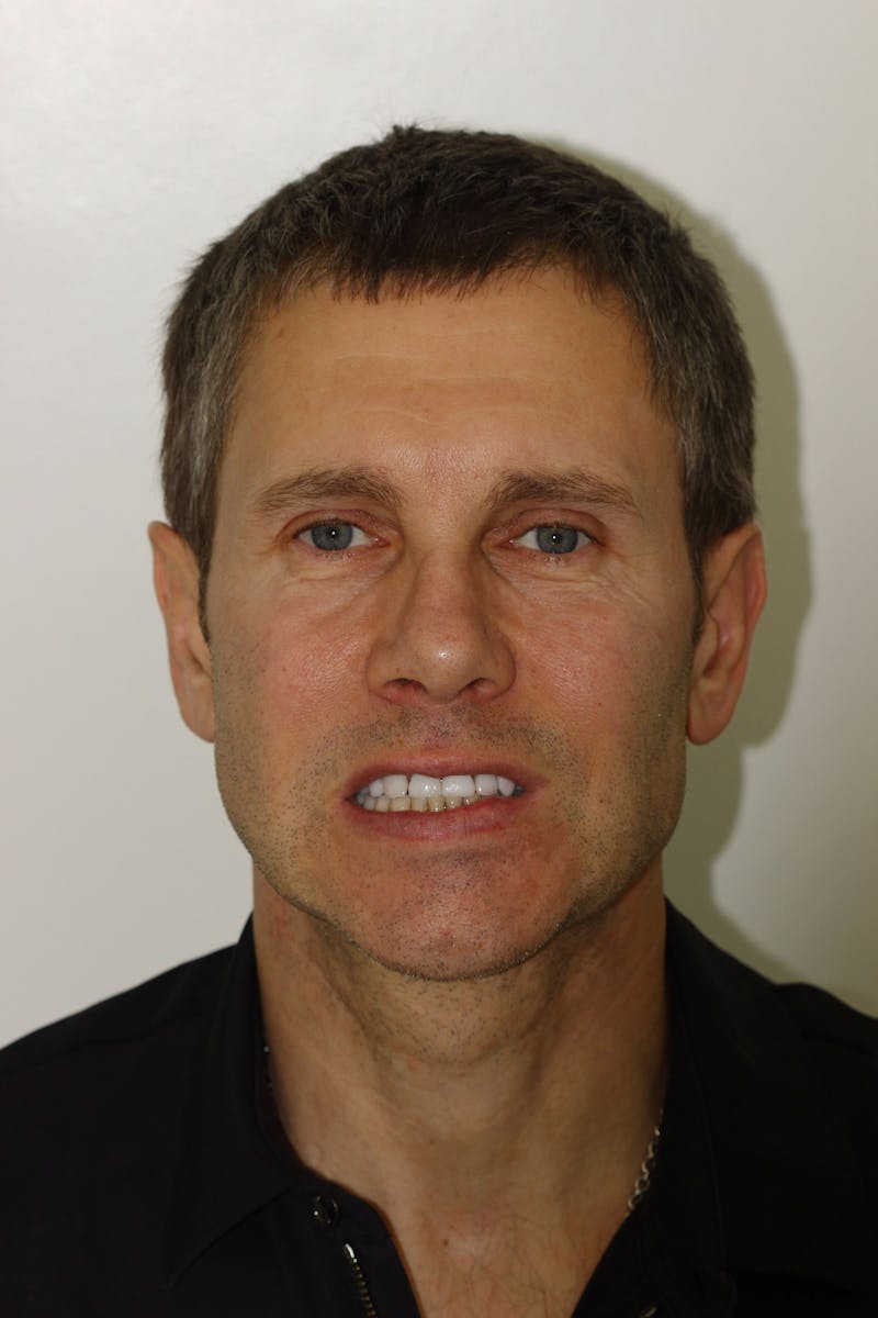 Patient Smile Before & After Gallery - Patient 421537 - Image 1