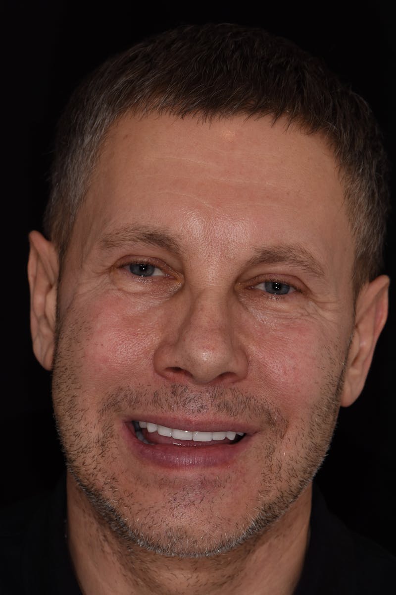 Patient Smile Before & After Gallery - Patient 421537 - Image 2