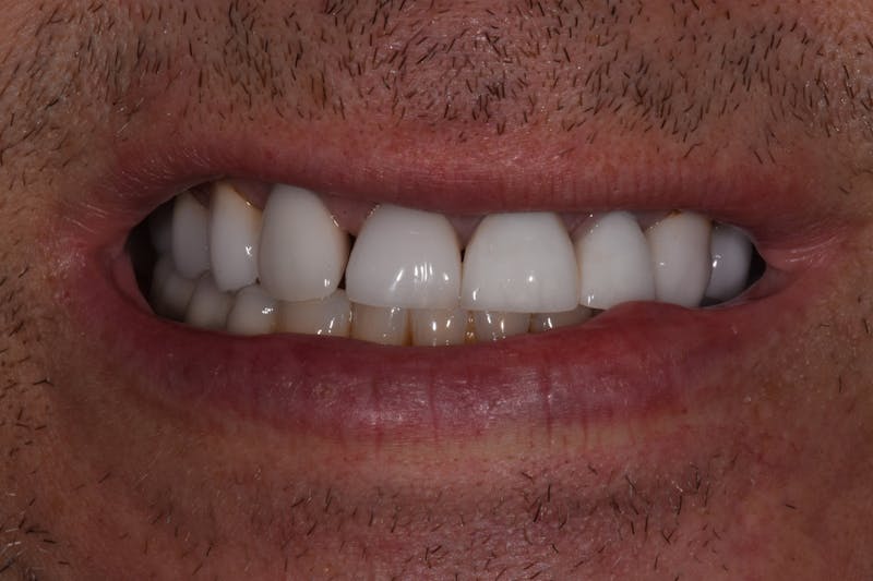 Patient Smile Before & After Gallery - Patient 421537 - Image 3
