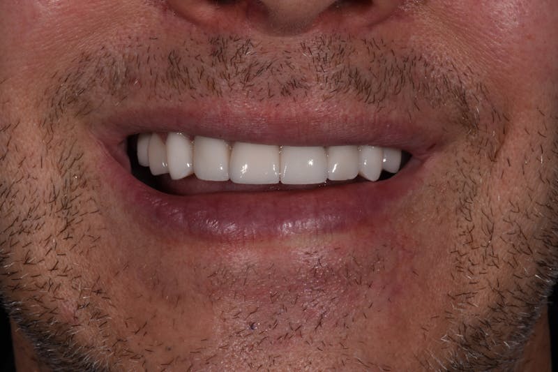 Patient Smile Before & After Gallery - Patient 421537 - Image 4