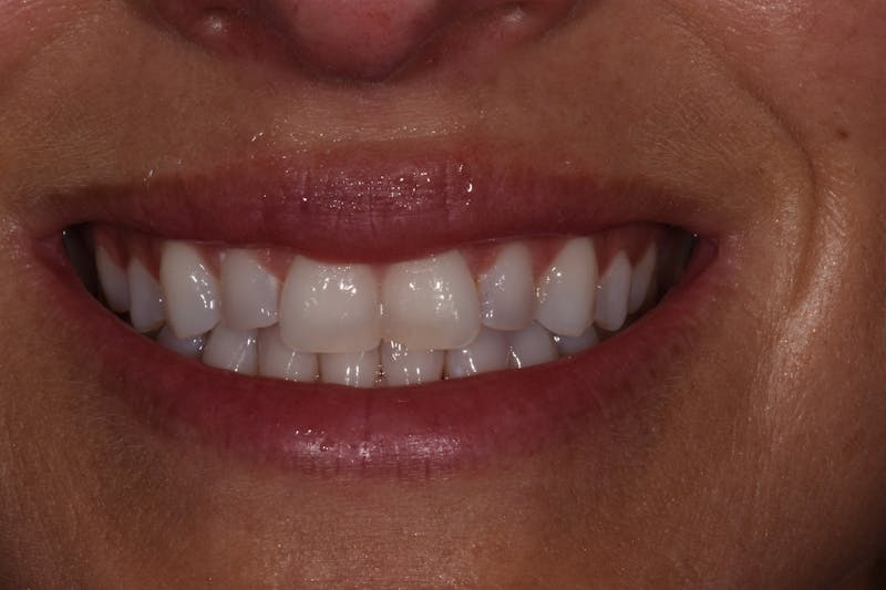 Patient Smile Before & After Gallery - Patient 332800 - Image 1