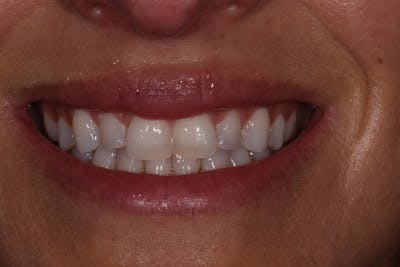Patient Smile Before & After Gallery - Patient 332800 - Image 1