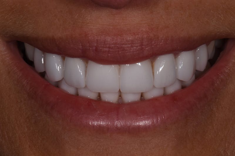 Patient Smile Before & After Gallery - Patient 332800 - Image 2