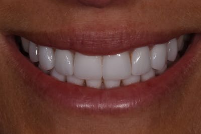 Patient Smile Before & After Gallery - Patient 332800 - Image 2