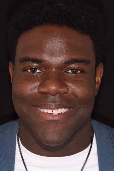 Patient Smile Before & After Gallery - Patient 302739 - Image 1