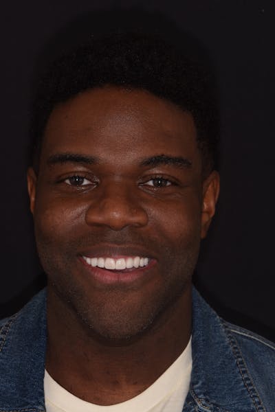 Patient Smile Before & After Gallery - Patient 302739 - Image 2