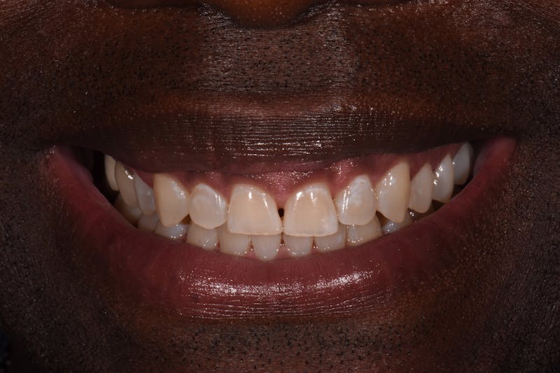 Patient Smile Before & After Gallery - Patient 302739 - Image 3