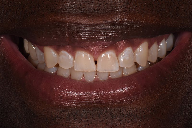 Patient Smile Before & After Gallery - Patient 349114 - Image 3