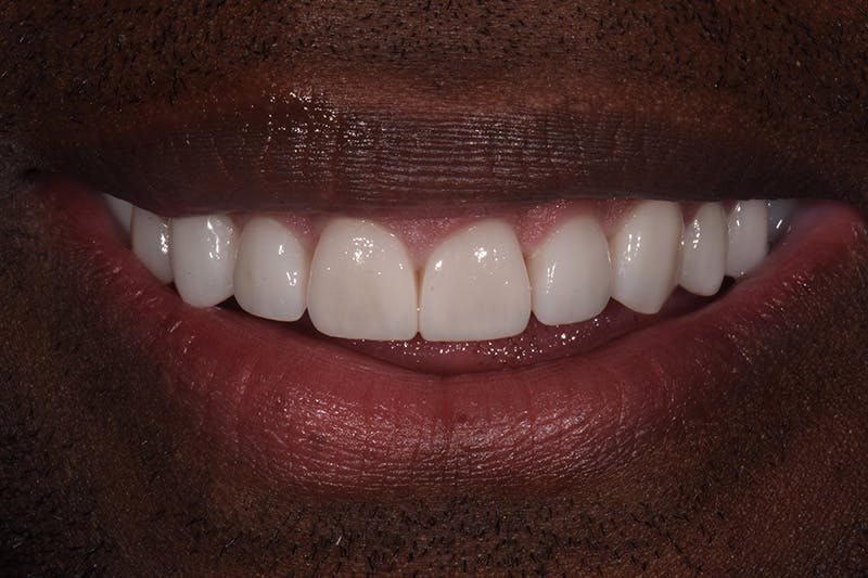 Patient Smile Before & After Gallery - Patient 349114 - Image 4