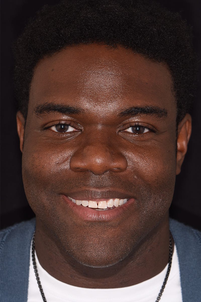 Patient Smile Before & After Gallery - Patient 349114 - Image 1