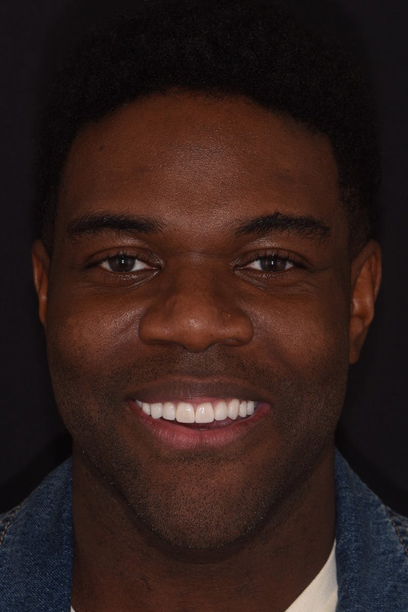 Patient Smile Before & After Gallery - Patient 349114 - Image 2