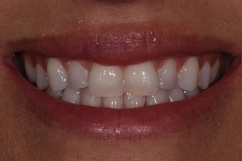 Patient Smile Before & After Gallery - Patient 237510 - Image 1