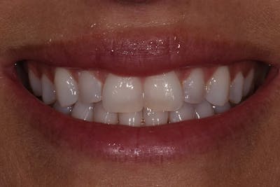 Patient Smile Before & After Gallery - Patient 237510 - Image 1