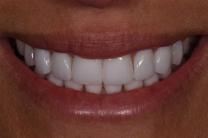 Patient Smile Before & After Gallery - Patient 237510 - Image 2