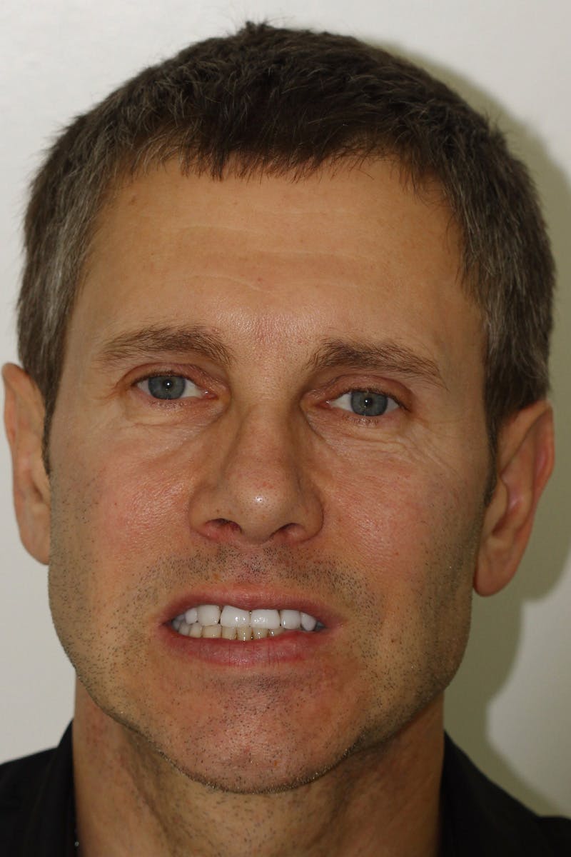 Patient Smile Before & After Gallery - Patient 148718 - Image 1