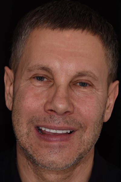 Patient Smile Before & After Gallery - Patient 148718 - Image 2